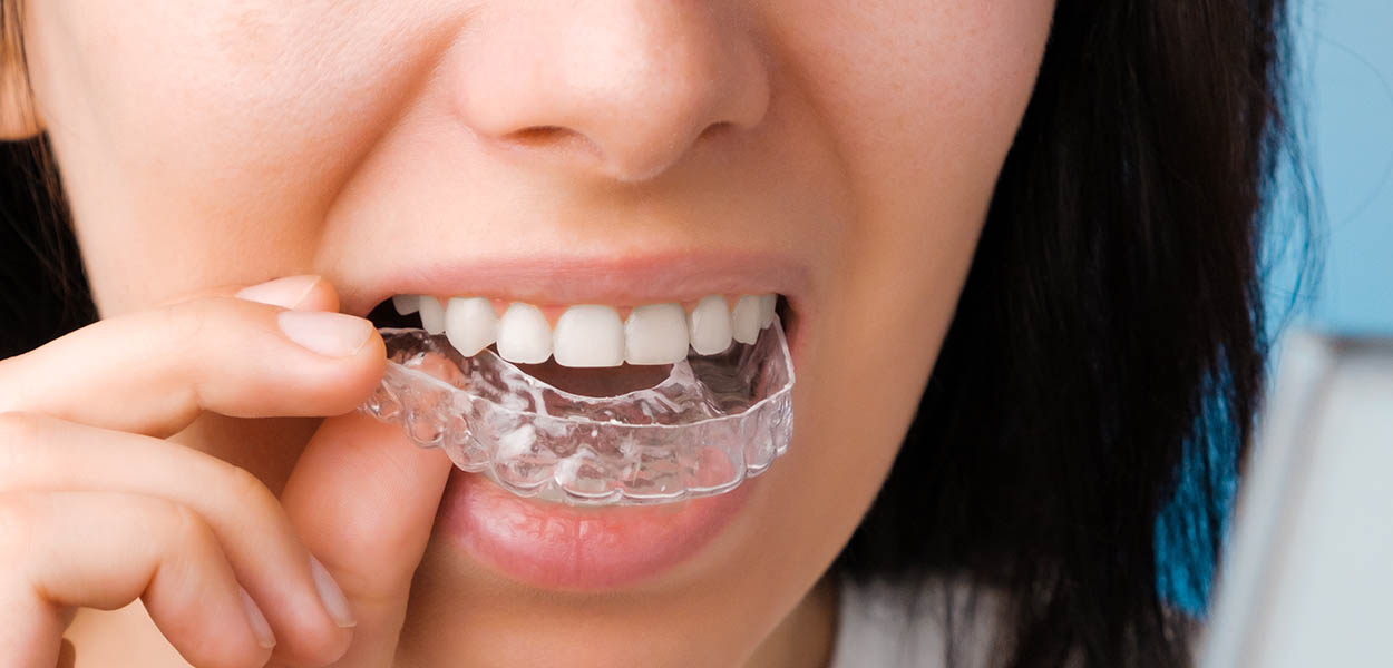 Remember To Wear Your Retainer