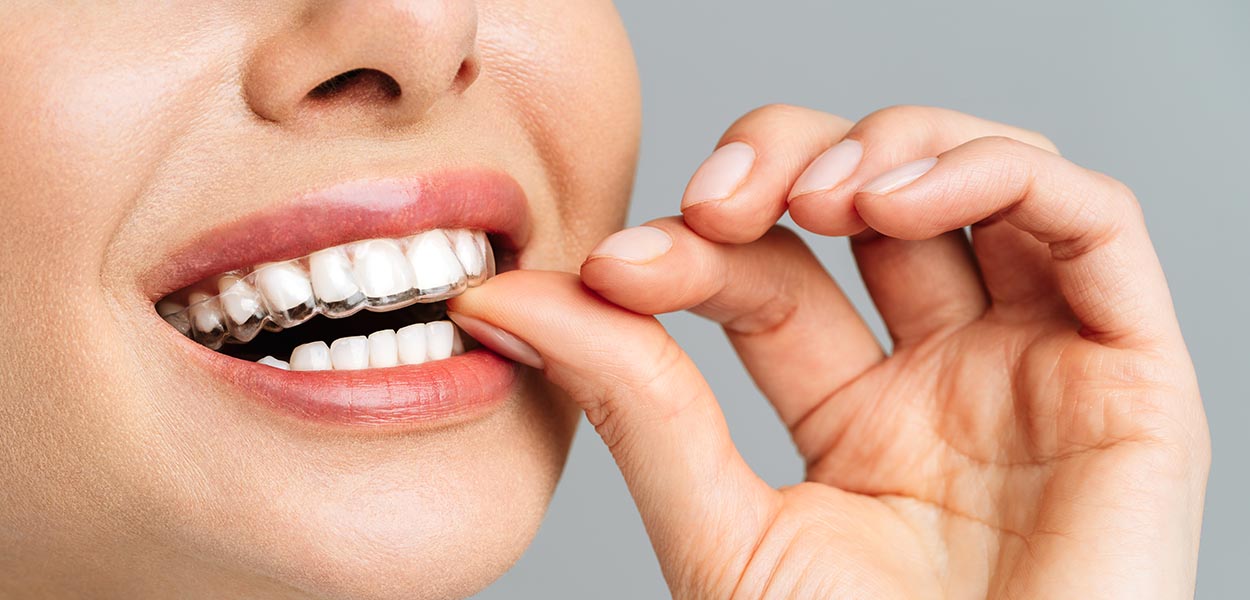 Invisalign Treatment What To Expect