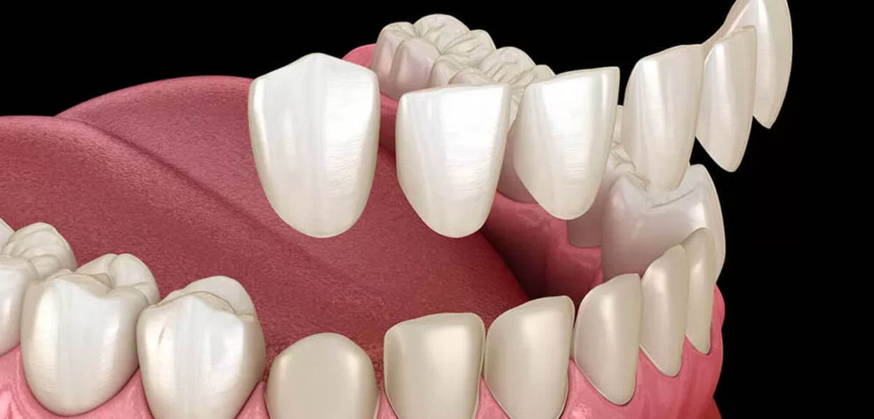 veneers instant orthodontics