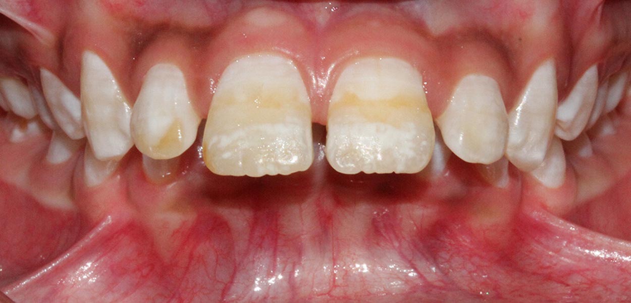 buck teeth overjet-orthodontist round lake il