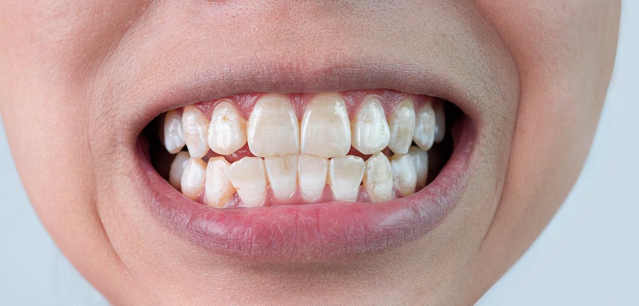 braces white spots on teeth