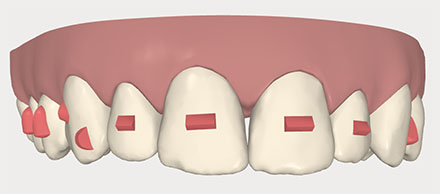 Invisalign buttons or attachments