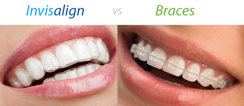 Invisalign-vs-clear-ceramic-braces