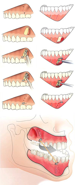 bollard plates surgery procedure for orthodontic treatment