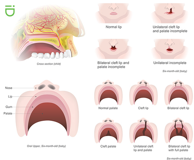 cleft lip and palate anatomy