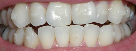 invisalign attachments without aligner