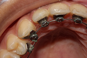Lingual braces real patient