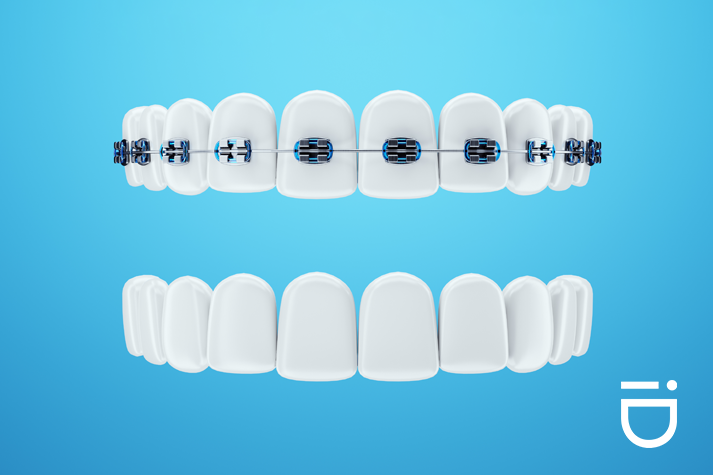 single-arch braces